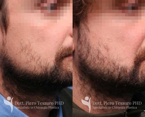 trapianto barba 1 post 1