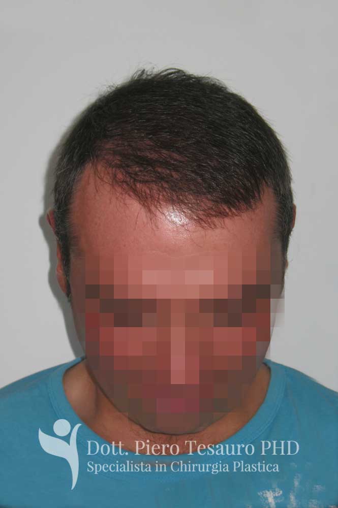 attaccatura frontale infoltimento anteriore 2