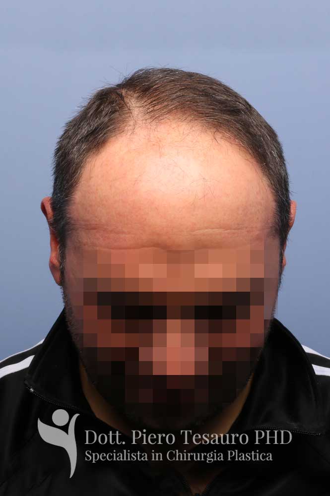 attaccatura frontale infoltimento anteriore 5