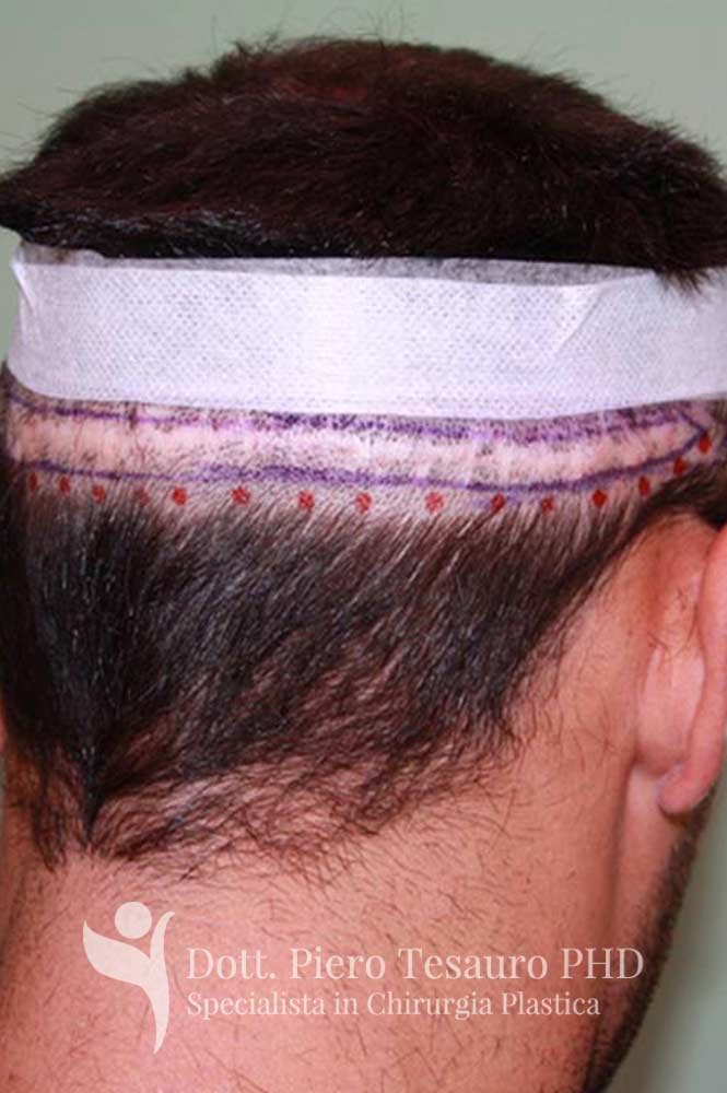 correzione diastasi cicatrice 1