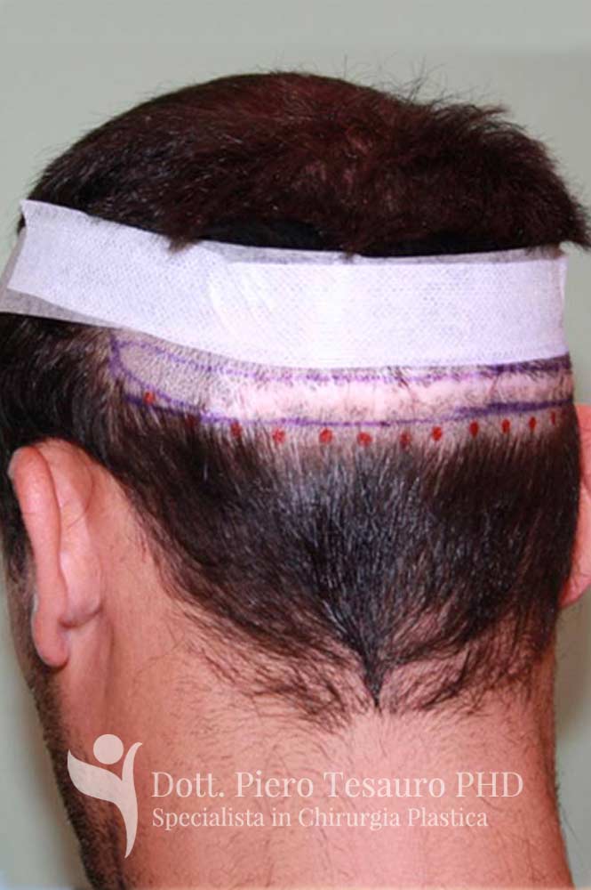 correzione diastasi cicatrice 3