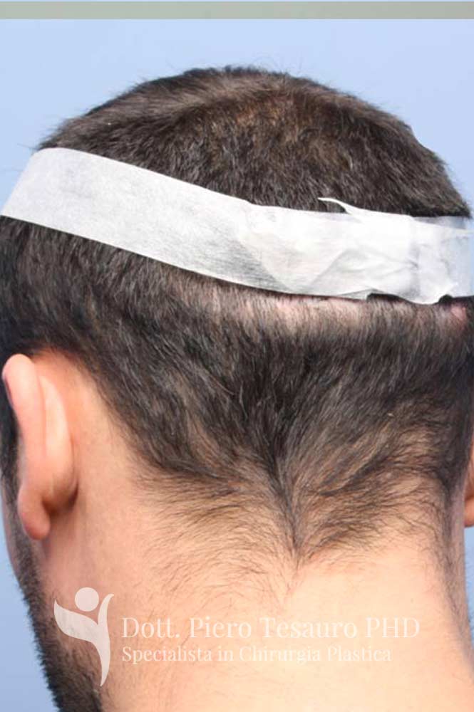 correzione diastasi cicatrice 4