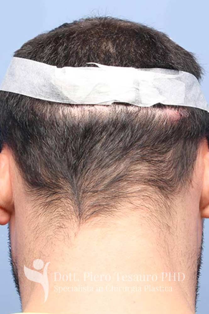 correzione diastasi cicatrice 6