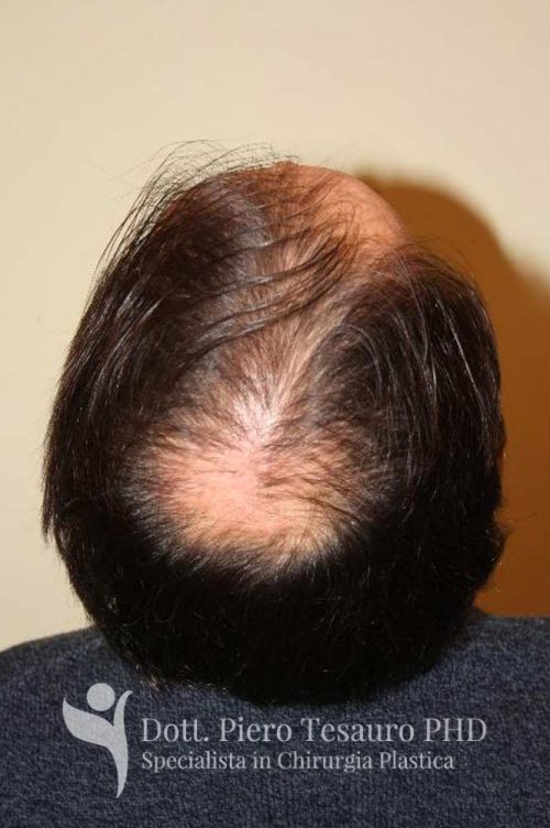 96+ Meraviglioso Infoltimento Capelli Milano Figure
