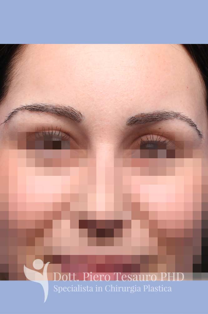 ricostruzione completa sopracciglia 2
