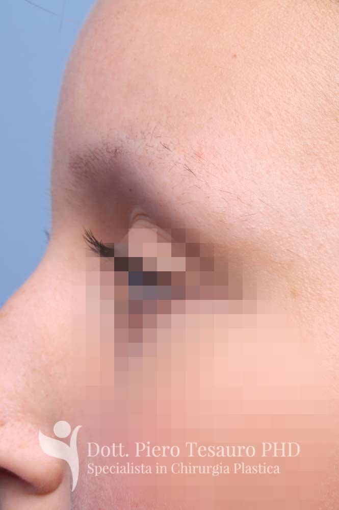 ricostruzione completa sopracciglia 3