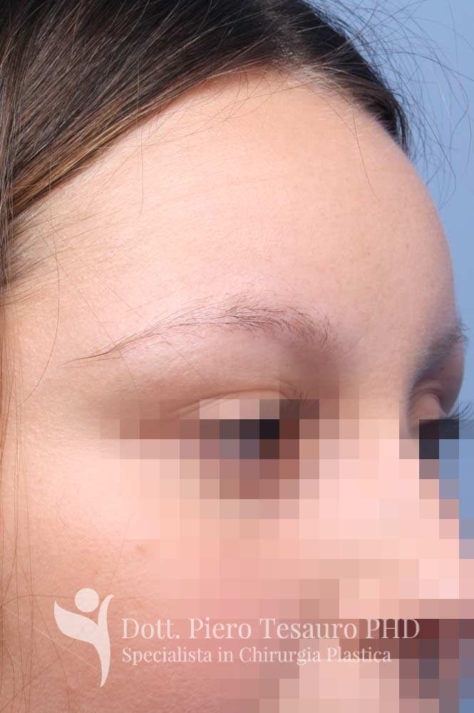 ricostruzione completa sopracciglia 5