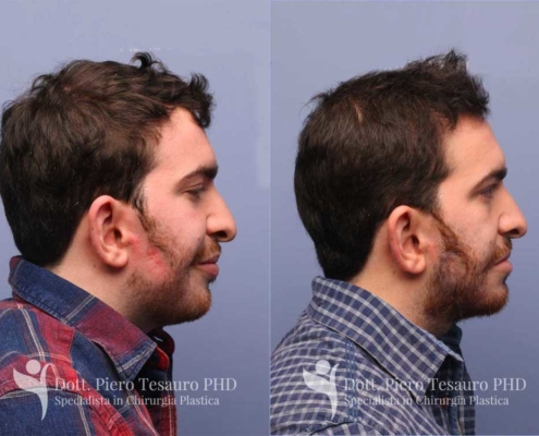 Autotrapianto barba pro barba