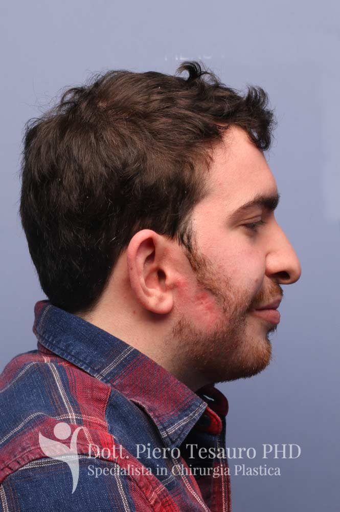 Autotrapianto barba pro barba2