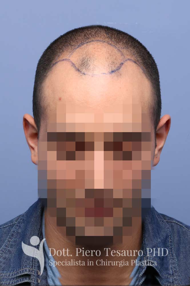 Trapianto capelli medie dimensioni 191