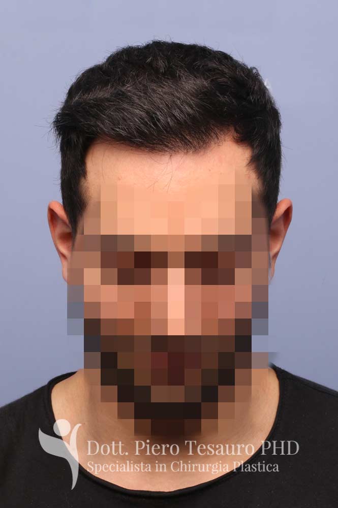 Trapianto capelli medie dimensioni 192
