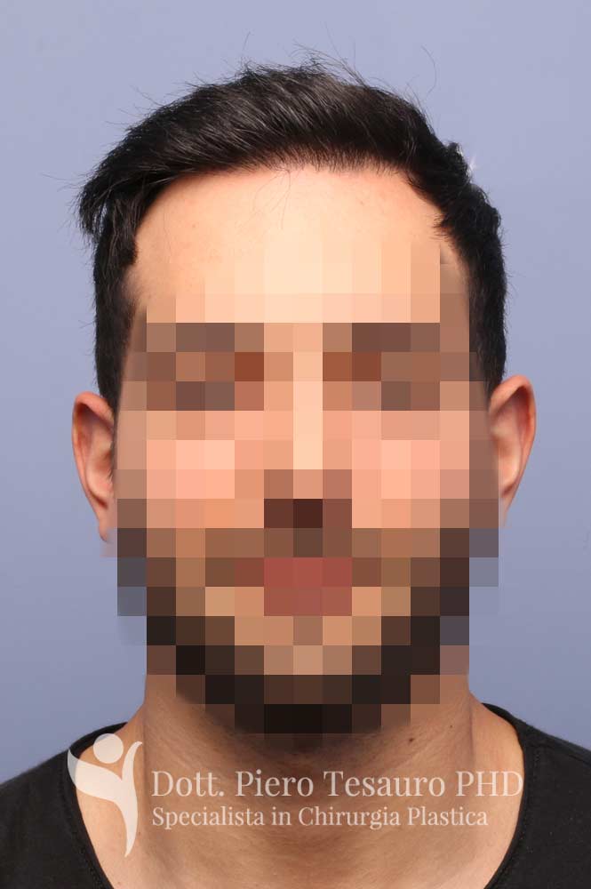 Trapianto capelli medie dimensioni 194