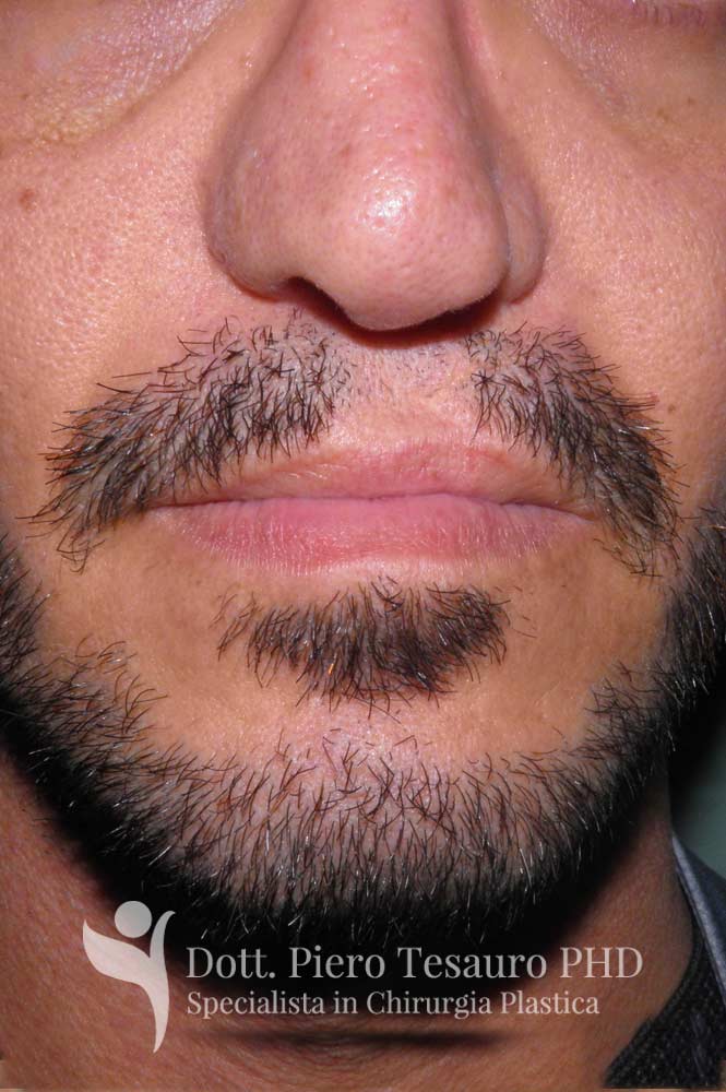 Trapianto ricostruttivo barba