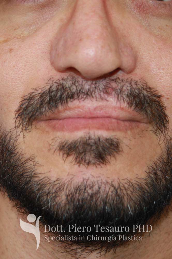 Trapianto ricostruttivo barba1