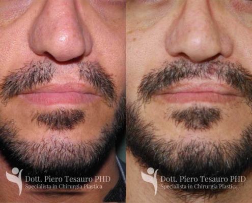 Trapianto ricostruttivo barba2