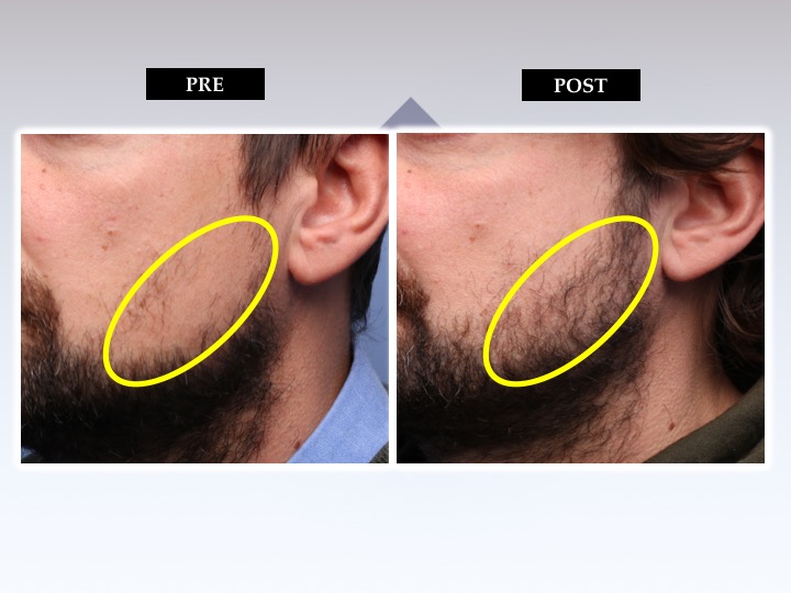 Diapositiva17 Trapianto barba e baffi
